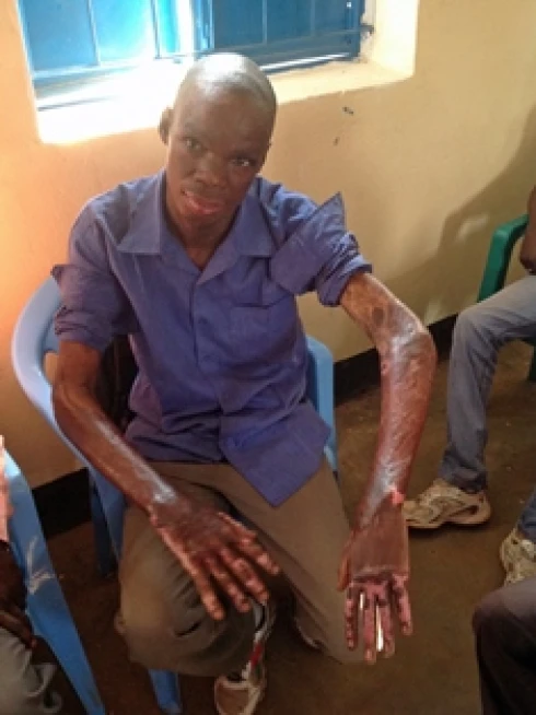 Much needed Vaseline reaches Maridi